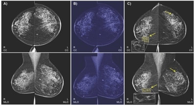 Part of the dataset for IBM breast cancer