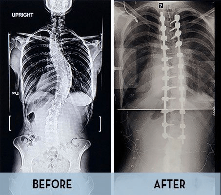 Patient x-ray after using Mazor X Stealth Edition