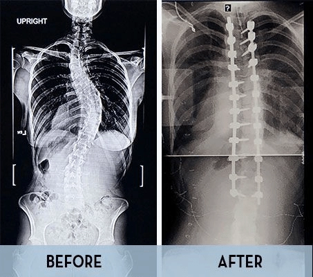 Patient x-ray after using Mazor X Stealth Edition